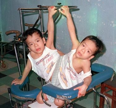 ベトちゃんドクちゃん